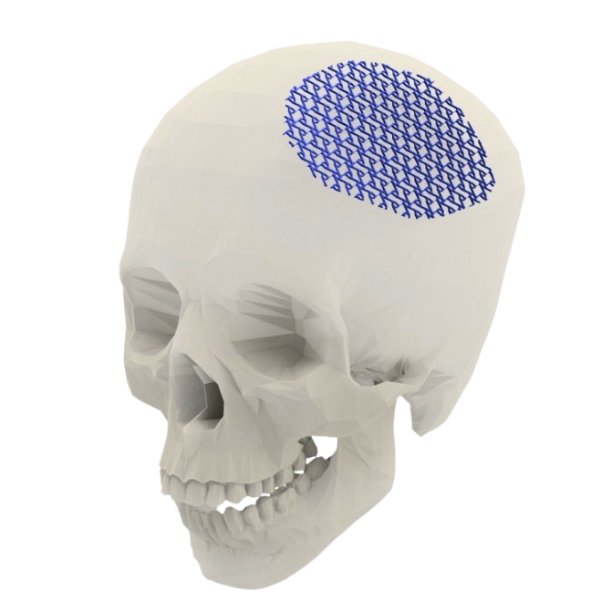 cranioplastica-.png
