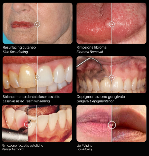 laser-per-odontoiatria-estetica.png